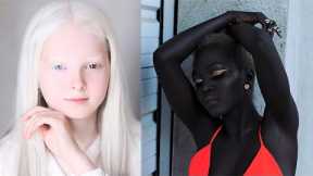 14 Imperfectly Perfect People With Most Unique Skin Color