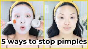5 Ways To Stop Acne & Pimples FAST!